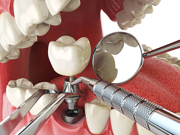 Best Emergency Broken Tooth Repair in Sonoma, CA